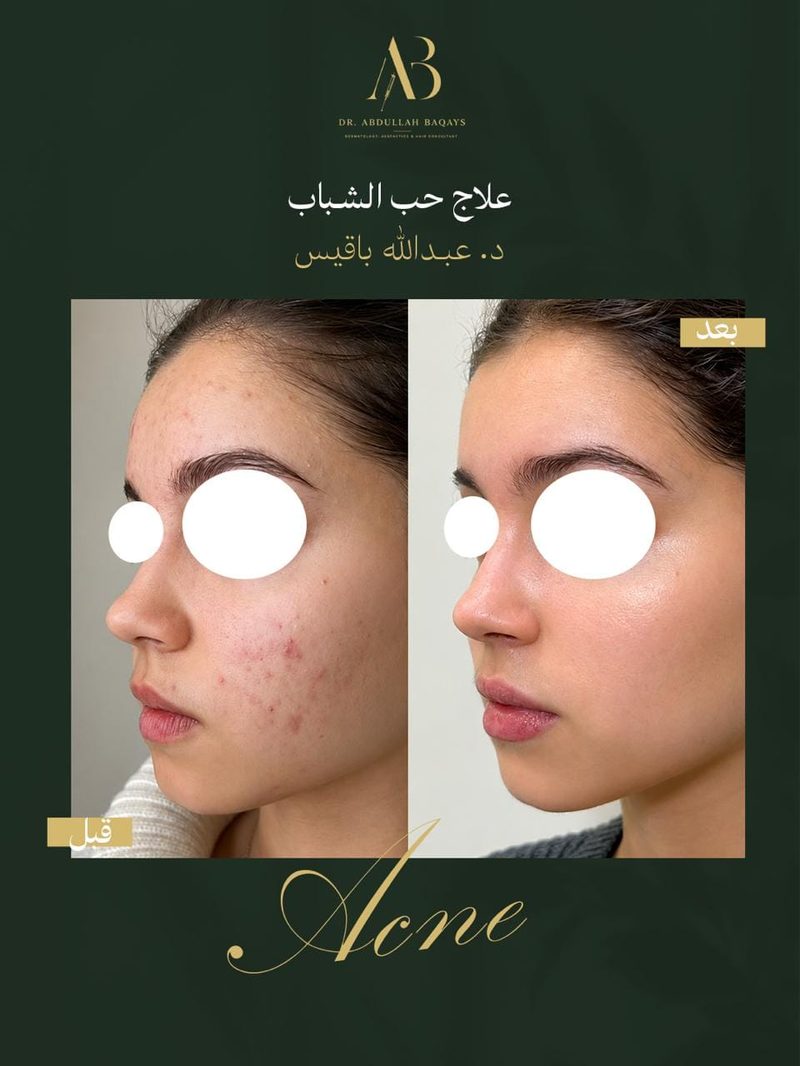 نتيجة علاج حب الشباب قبل وبعد — د. عبدالله باقيس | Acne treatment before and after