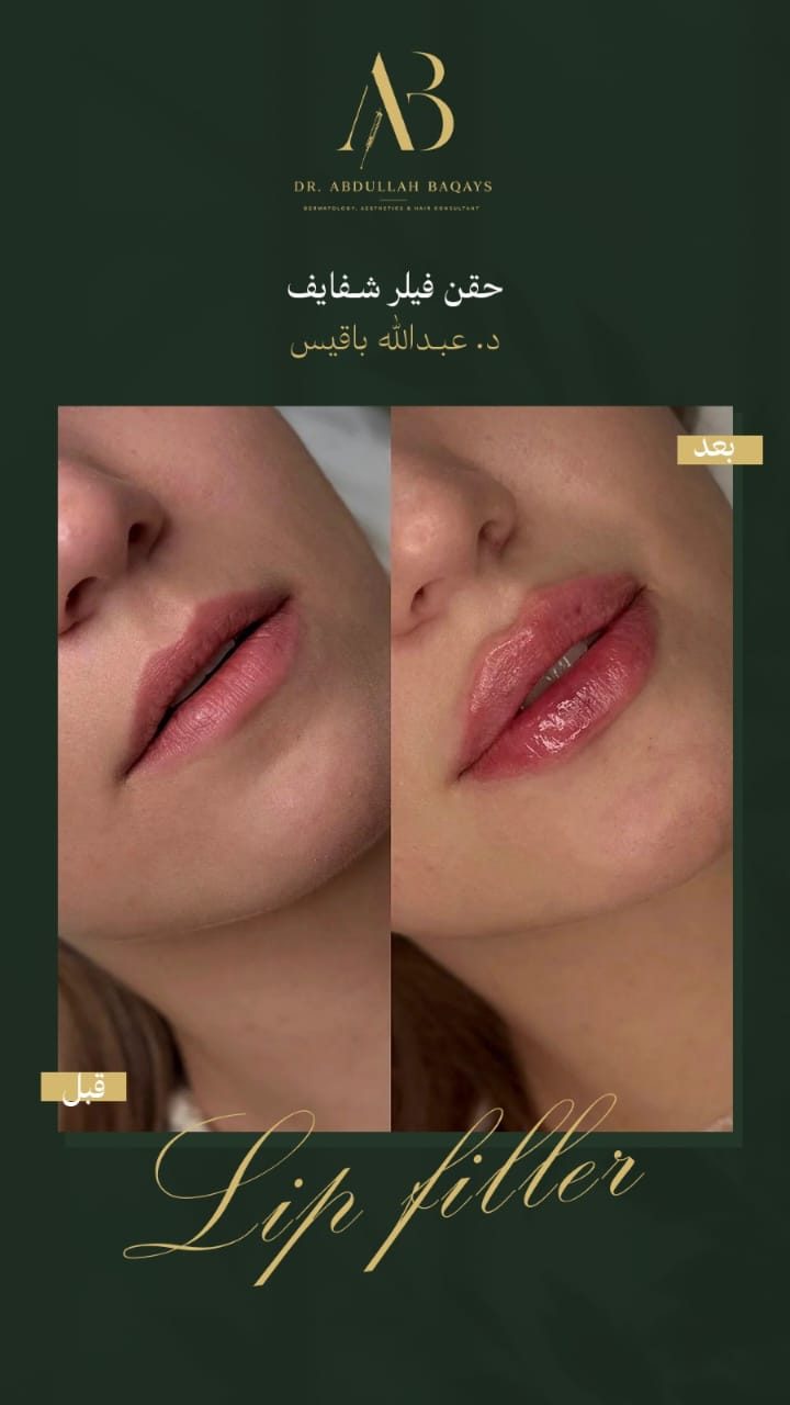 نتيجة حقن فيلر شفايف قبل وبعد — حالة 1 — د. عبدالله باقيس | Lip Filler results