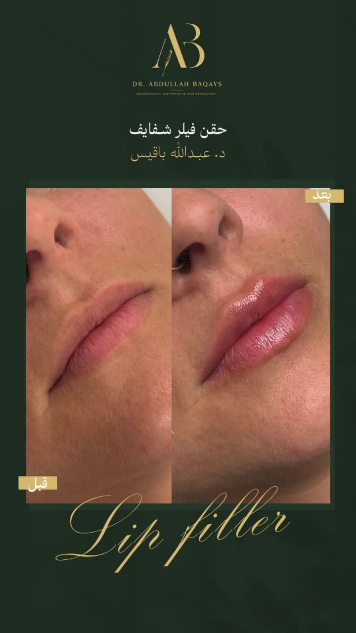 نتيجة حقن فيلر شفايف قبل وبعد — حالة 2 — د. عبدالله باقيس | Lip Filler results