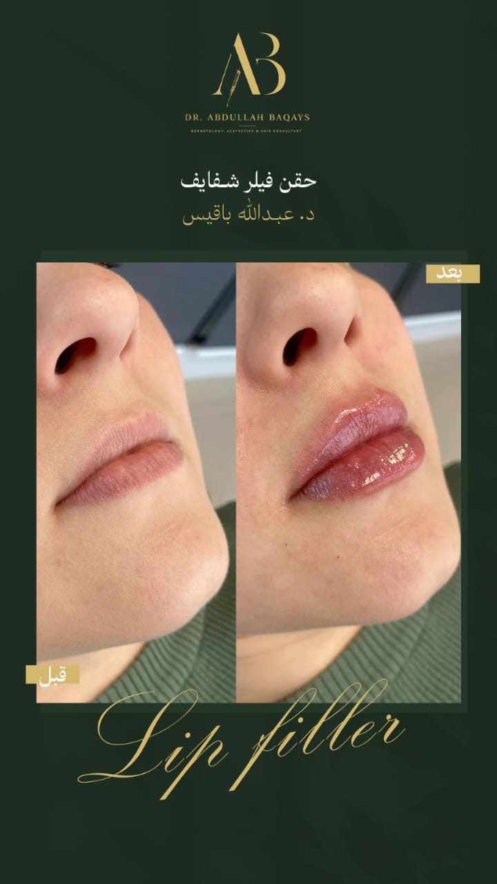 نتيجة حقن فيلر شفايف قبل وبعد — حالة 4 — د. عبدالله باقيس | Lip Filler results