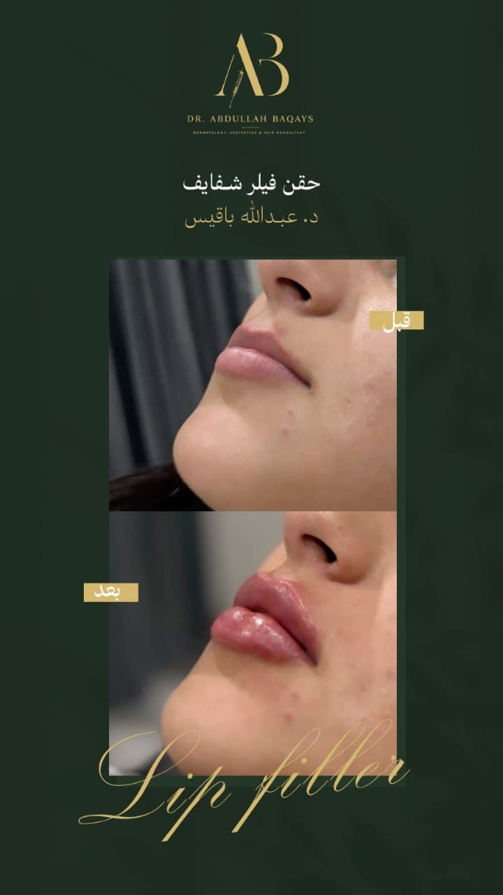 نتيجة حقن فيلر شفايف — حالة 7 — د. عبدالله باقيس