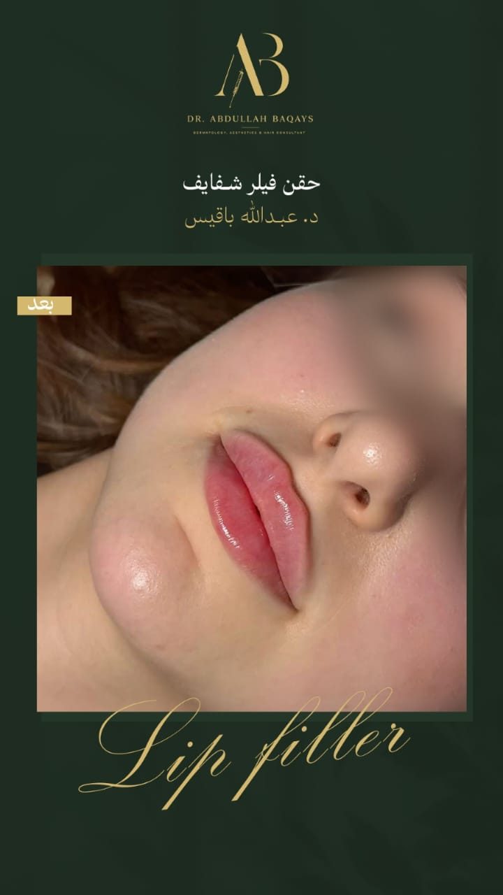 نتيجة حقن فيلر شفايف — بعد — د. عبدالله باقيس
